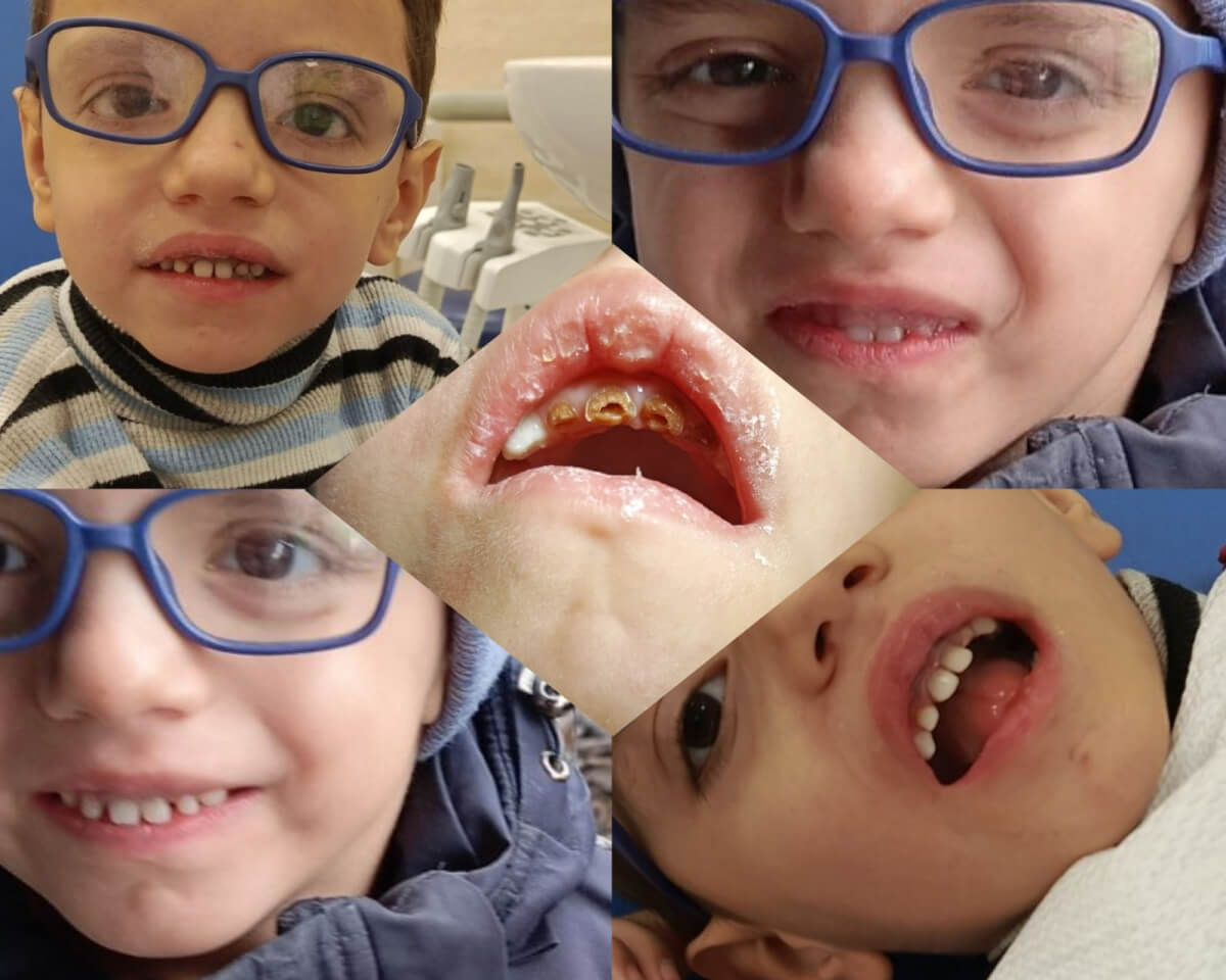 Магічне відновлення зубчиків (english version below)